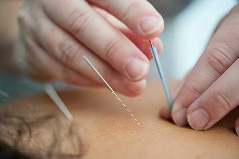 managing-menopause-symptoms-naturally-accupuncture